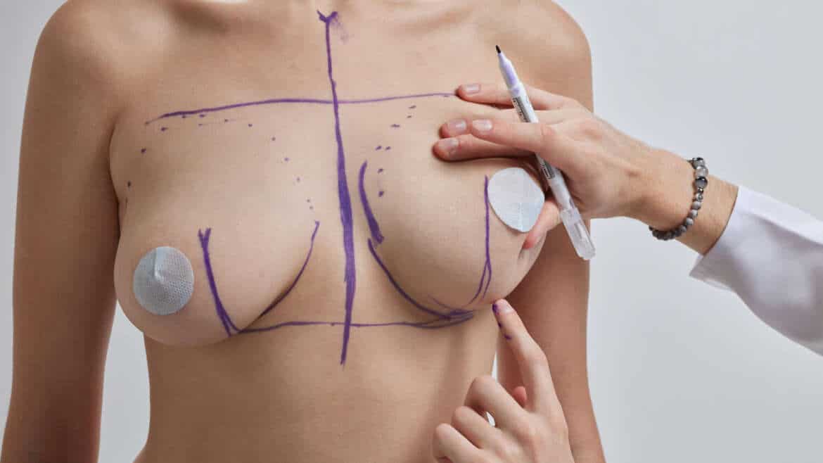 Reducción Mamaria: Beneficios Más Allá de la Estética Cómo este procedimiento puede mejorar la salud física y el bienestar emocional